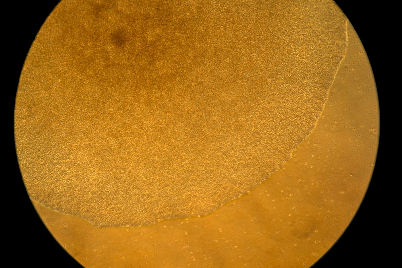 Lifelong drugs for autoimmune diseases don't work well. Now scientists are trying something new | iNFOnews.ca